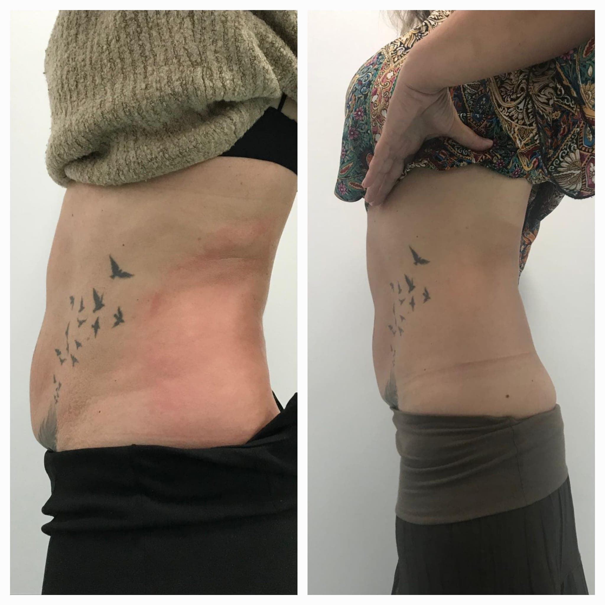 Body Sculpt™ abdomen